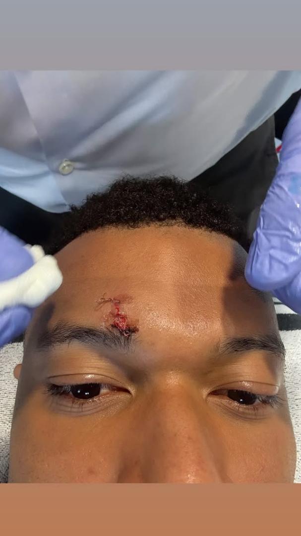 Publikohet pamje nga dëmtmi i vetullës së Mbappes